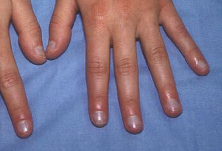 Observe as suas unhas para fazer diagnósticos de saúde