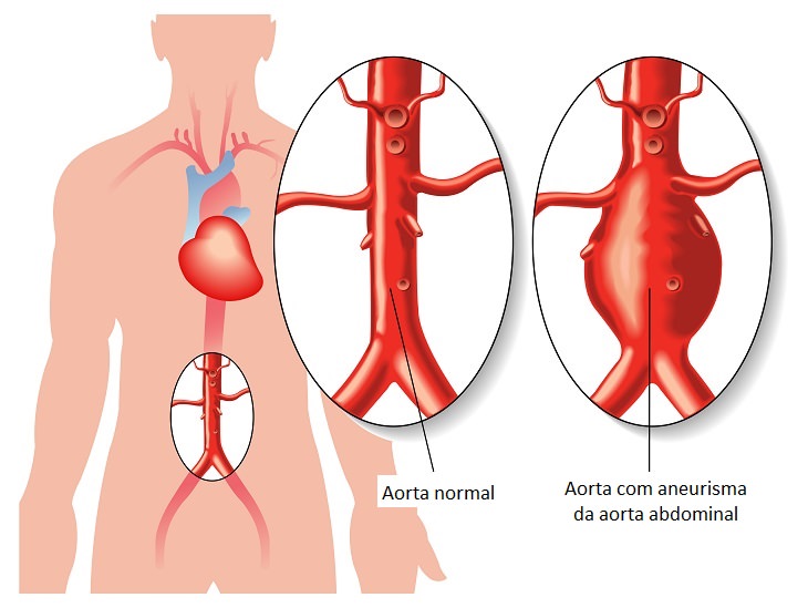 Alerta de saúde: Saiba tudo sobre aneurisma da aorta