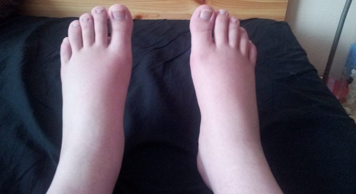 sintomas de doenças nos pés