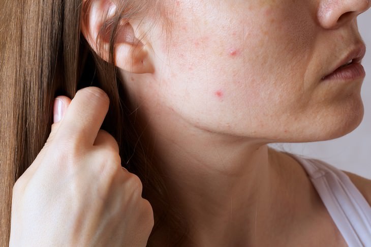 14 Sintomas de estresse que merecem atenção mulher com acne