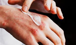 É eczema ou apenas pele seca? Como diferenciar os dois