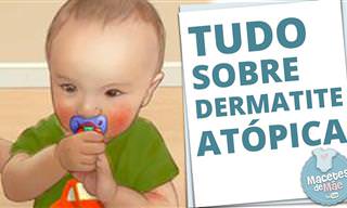 Guia d esaúde: Dermatite atópica em crianças