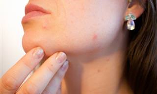 Como Prevenir e Tratar a Acne