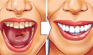 Remova o tártaro dos seus dentes de forma natural