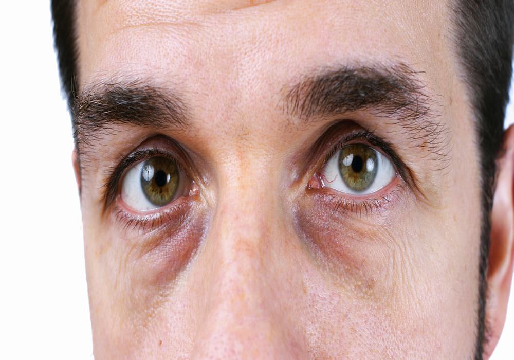 Мешки под глазами причина у мужчин лечение. Впавшие глаза.